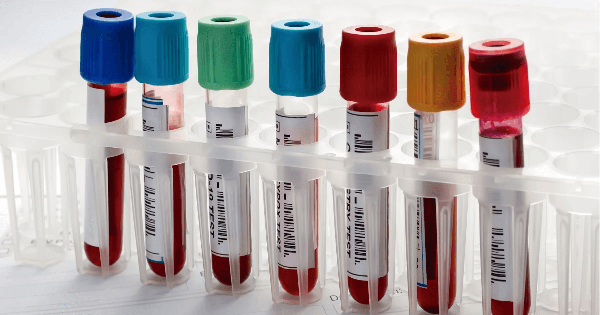 Labelled blood collection tubes with coloured caps in a laboratory rack, each barcode linking the sample to a patient